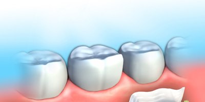 השתלות שיניים