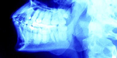 בדיקת CT לשיניים