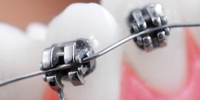 יישור שיניים