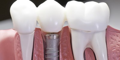 השתלות שיניים (אילוסטרציה)