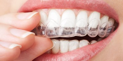 יישור שיניים במצבים מורכבים (אילוסטרציה)