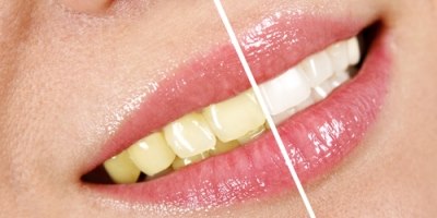 ציפוי שיניים (אילוסטרציה)