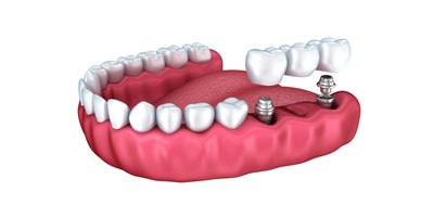 השתלת שיניים בסוכרתיים (אילוסטרציה צילום shutterstock)