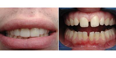 לפני ואחרי הטיפול ברווח בשיניים. צילום: ד"ר אבידן לרון