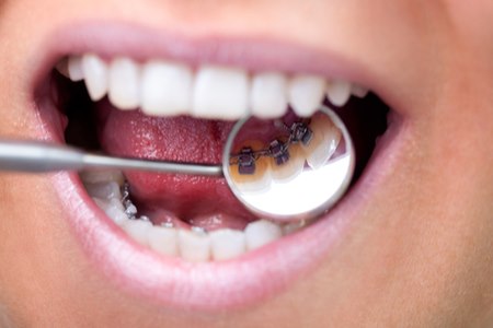 בשיטת האינקוגניטו ממקמים את הסמכים בחלק הפנימי של השיניים. צילום: שאטרסטוק