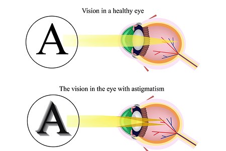 עין בריאה מול עין עם אסטיגמציה. אילוסטרציה: שאטרסטוק