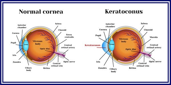 משמאל - קרנית עין בריאה, מימין - קרית עם קרטוקונוס. אילוסטרציה: שאטרסטוק