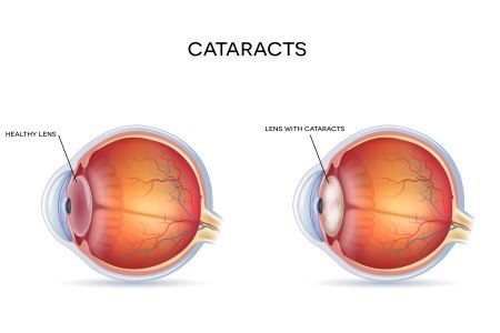 משמאל: עין בריאה, מימין: קטרקט - עדשת העין עכורה. אילוסטרציה: שאטרסטוק
