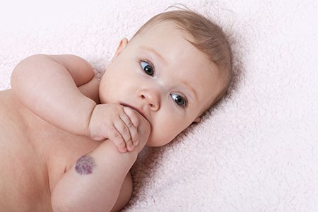 המנגיומה על זרוע תינוקת (אילוסטרציה shutterstock)