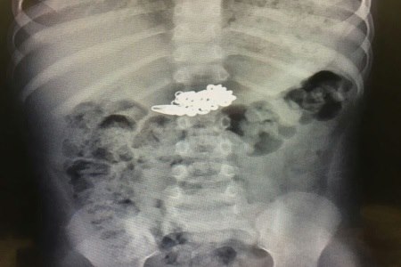 צילום רנטגן של קיבת הפעוט עם השרשרת. צילום: באדיבות דוברות רמב"ם