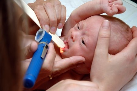 בד"כ התופעה תתגלה ע"י רופא הילדים, לאחר הלידה. צילום: thinkstock