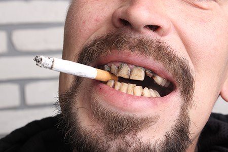 גורמי סיכון: עישון והרס ניכר של השיניים (אילוסטרציה shutterstock)