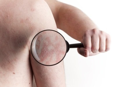 נגעי הלימופמה בעור מחקים מחלות עור אחרות, כגון פסוריאזיס. צילום: thinkstock