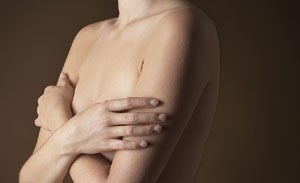 סרטן השד: כריתה ושחזור שד (אילוסטרציה)