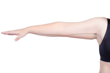 ניתוח מתיחת זרועות משלב לעיתים שאיבת שומן ומתיחת העור. צילום: thinkstock