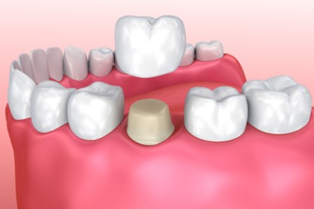 ציפוי חרסינה שמולבש על השיניים, מעניק חיוך טבעי ומושלם. צילום: שאטרסטוק