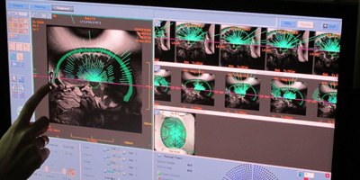 ניתוח מוח בחולה פרקינסון ללא הרדמה (צילום: דוברות רמב"ם)