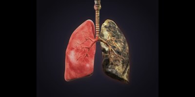 COPD חסמת ריאה. אילוסטרציה: שאטרסטוק