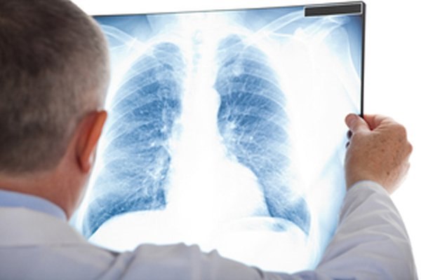 חולה המועמד להשתלת ריאה עובר בדיקה מקיפה במכון הריאה. צילום: שאטרסטוק
