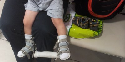 קלאב פוט - נעליים וסד בזמן טיפול (צילום: ד"ר יורם חמו)