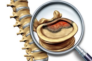 מנינגיומה בעמוד השדרה: מדריך - תמונה