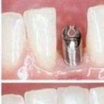 פורום חדש: שתלים דנטליים