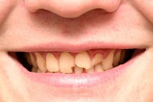 שיניים שבורות - יש פתרונות (אילוסטרציה shutterstock)