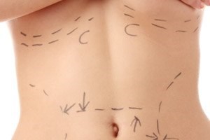 בודי ליפט אחרי דיאטה: לעור שלום-תמונה