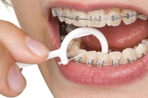 יישור שיניים למבוגרים (אילוסטרציה)