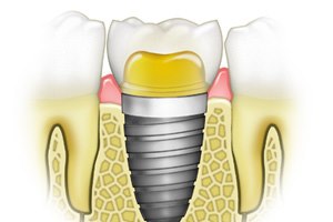 השתלת שיניים (אילוסטרציה)