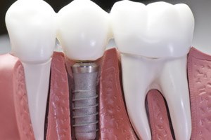 שתלים דנטליים: כל הלסת ביום אחד