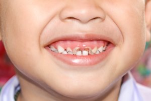 אורתודנטיה: יישור שיניים לילדים-תמונה