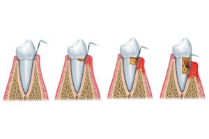 השתלת חניכיים (אילוסטרציה)