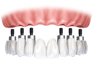 השתלת שיניים: ביום אחד, בלי כאבים