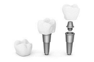 השתלת שיניים - כל השלבים-תמונה