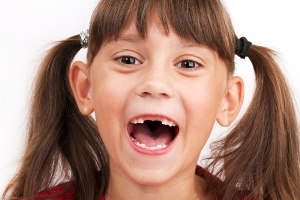 רווח בין השיניים. אילוסטרציה: שאטרסטוק