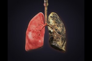 מחלות ריאה: בגלל העישון-תמונה