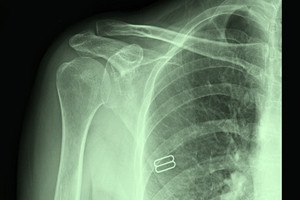 כתף קפואה: כיצד מטפלים?-תמונה