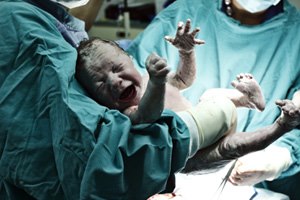 הרדמה כללית בלידה - תמונת אווירה