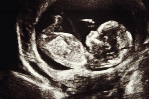 פגם במחיצה הבין חדרית - תמונת המחשה