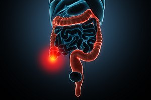 פוליפים במעי הגס - תמונת המחשה