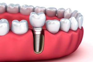 שתלים דנטליים? עדיף שיניים טבעיות!