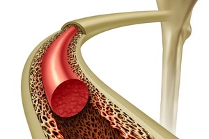 בדיקת מח עצם: מתי ולמה?-תמונה