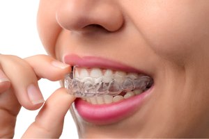 יישור שיניים שקוף: Invisalign