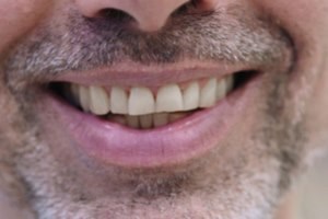 תותבת על שתלים: פתרון לאתגרים-תמונה