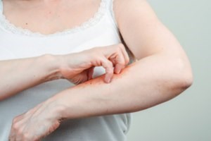 לימפומה של העור: טיפול משולב-תמונה