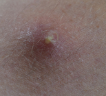 מורסה (אבצס): אבחון וטיפול-תמונה