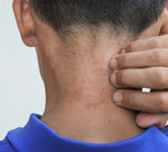 סקביאס: לטפל, במקום לגרד!-תמונה