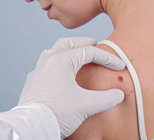 הסרת נקודות חן בלייזר - תמונת המחשה