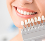 הלבנת שיניים בעזרת ציפוי - תמונת המחשה